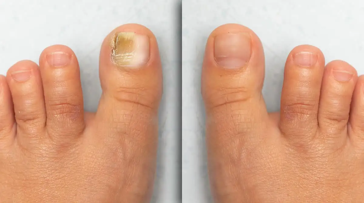 KeryFlex Cosmetic Nail Restoration by Integrity Foot And Ankle Associates in Lorain OH