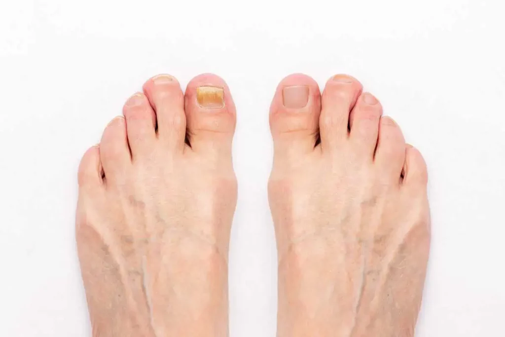 Toenail Fungus Integrityfootandankle