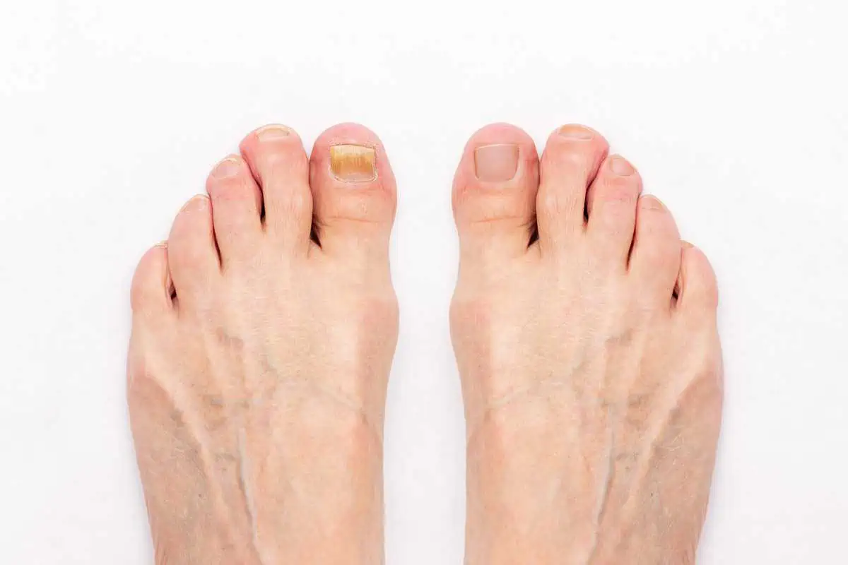 Toenail Fungus Integrityfootandankle