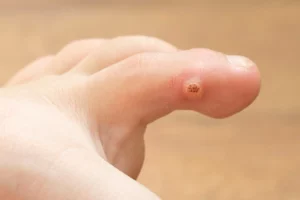 Warts on Toe Finger | INtegrity Foot and Ankle